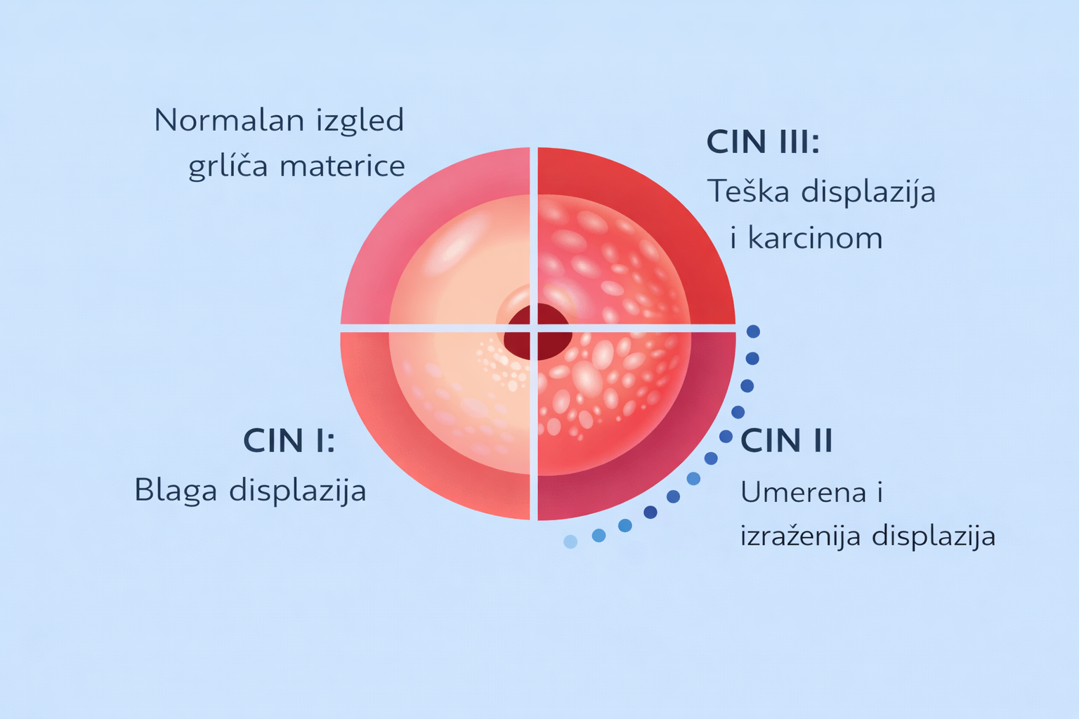 cervikalna displazija