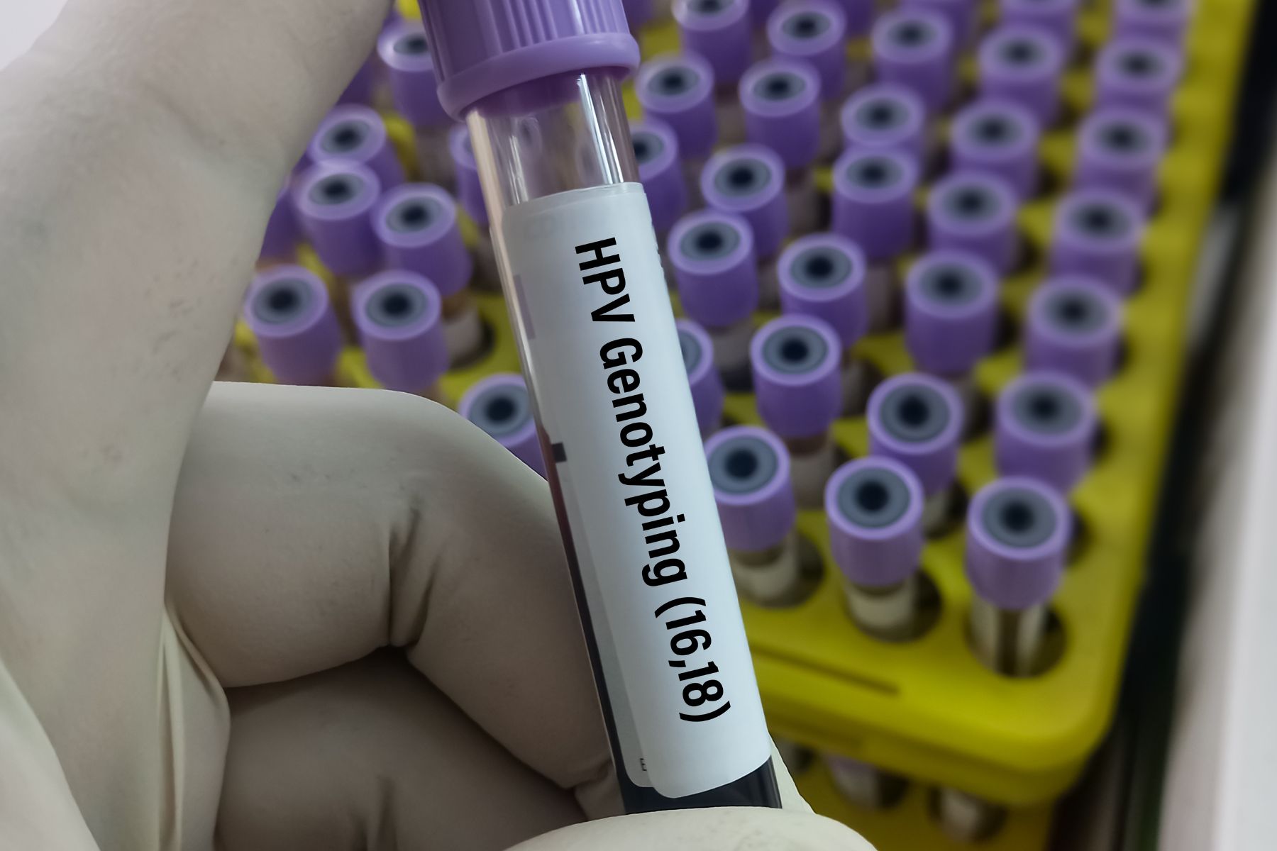 HPV16 i HPV18 – šta treba znati o ovim visokorizičnim tipovima