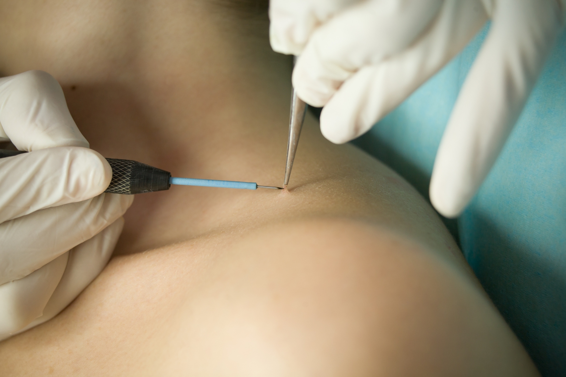 Da li su sve bradavice izazvane HPV-om? Donosimo objašnjenje